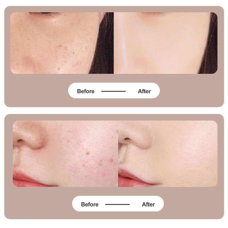 Avtoit | Plasma Pen Laser for Tattoo and Mole Removal
