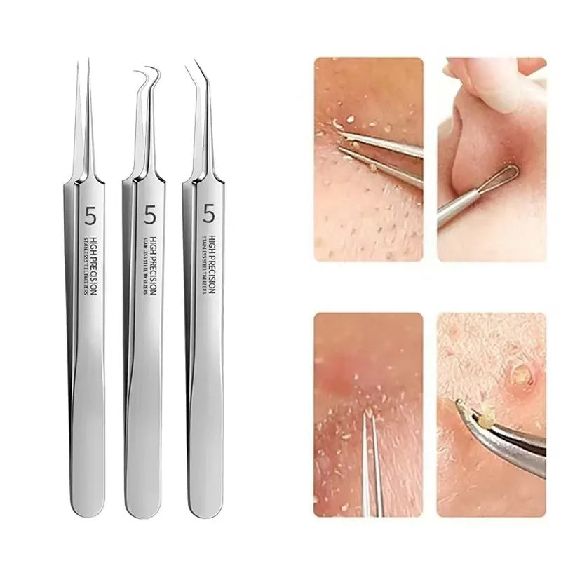 Avtoit | Tweezer for Removing Blackheads on the Face