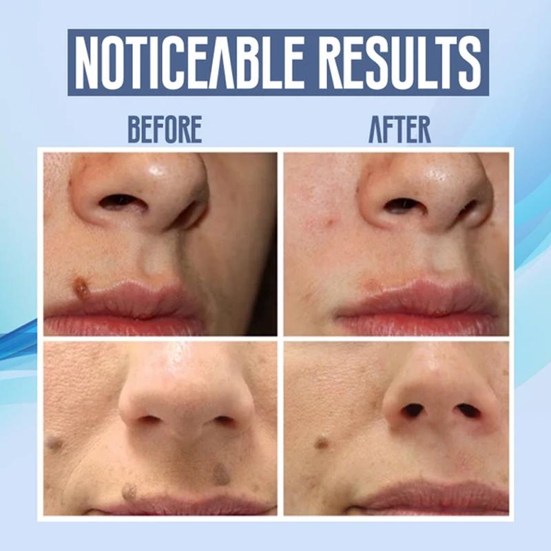 Avtoit | Facial Hair Removal Pen