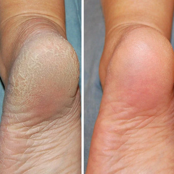 Avtoit | Silicon-Spa-Socks - Intensive care for cracked and tired feet
