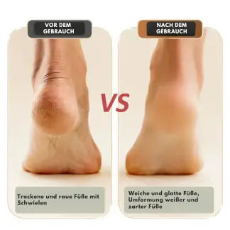 Avtoit | Electric Callus Remover